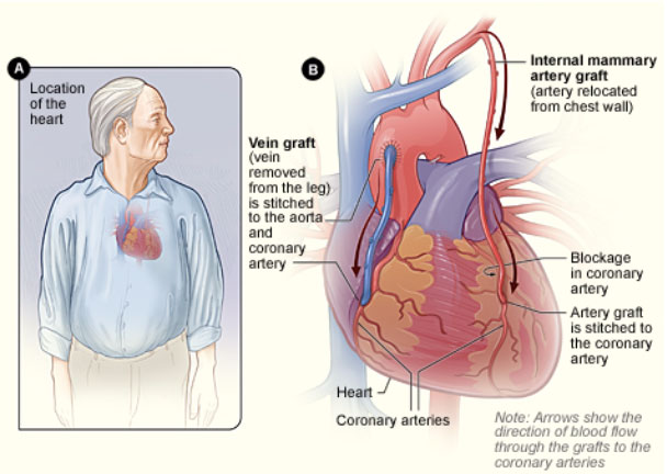 Coronary Artery Bypass Surgery – A Fascinating Evolution of Technique and Innovation
