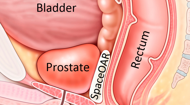 Prostate cancer facts and Treatment