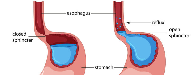 Gastroesophageal Reflux Disease -GERD – Heartburn